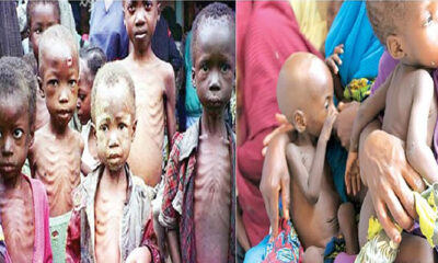 MALNUTRITIONED CHILDREN